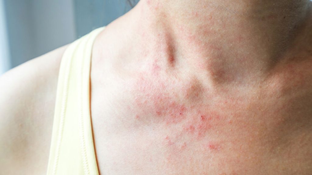 Skin rash as a sign of illness