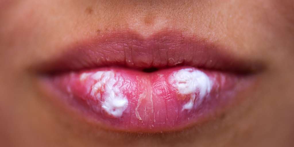 Cold sores - what to do?  Safe but annoying infection
