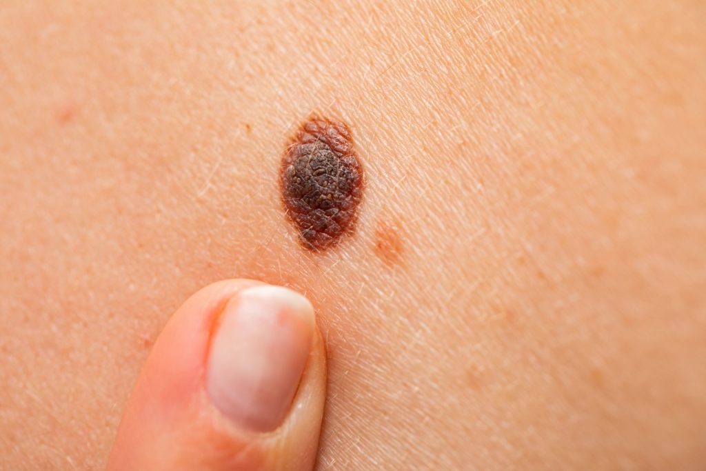 Fighting aggressive melanoma with killer cells - a healing practice